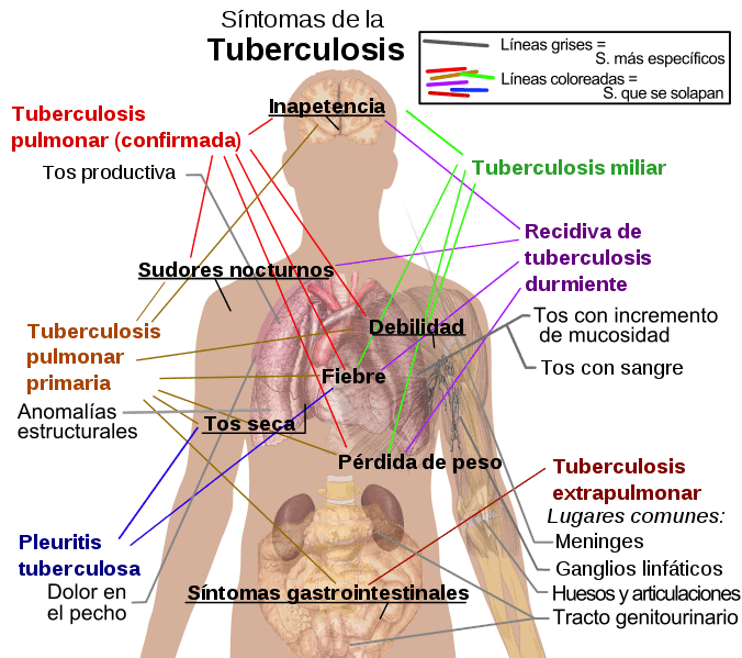 Síntomas de la tuberculosis. | Foto: Wikipedia Síntomas de la tuberculosis. | Foto: Wikipedia