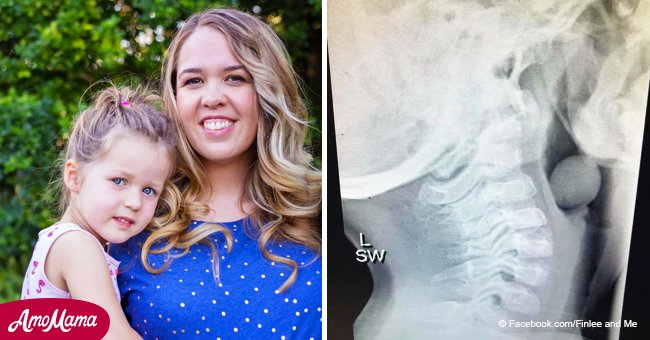 Terrifying X-ray of grape stuck in child's throat goes viral as a reminder for parents