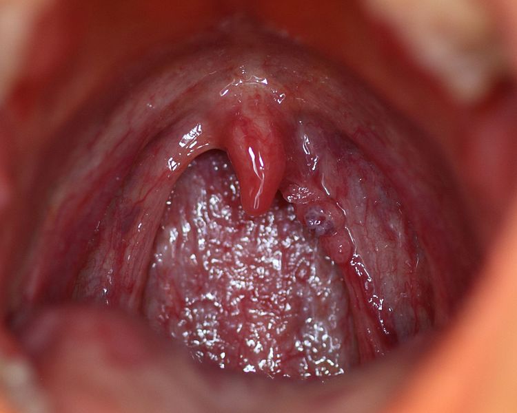 papillomavirus et mal de gorge helminti în materiile fecale umane