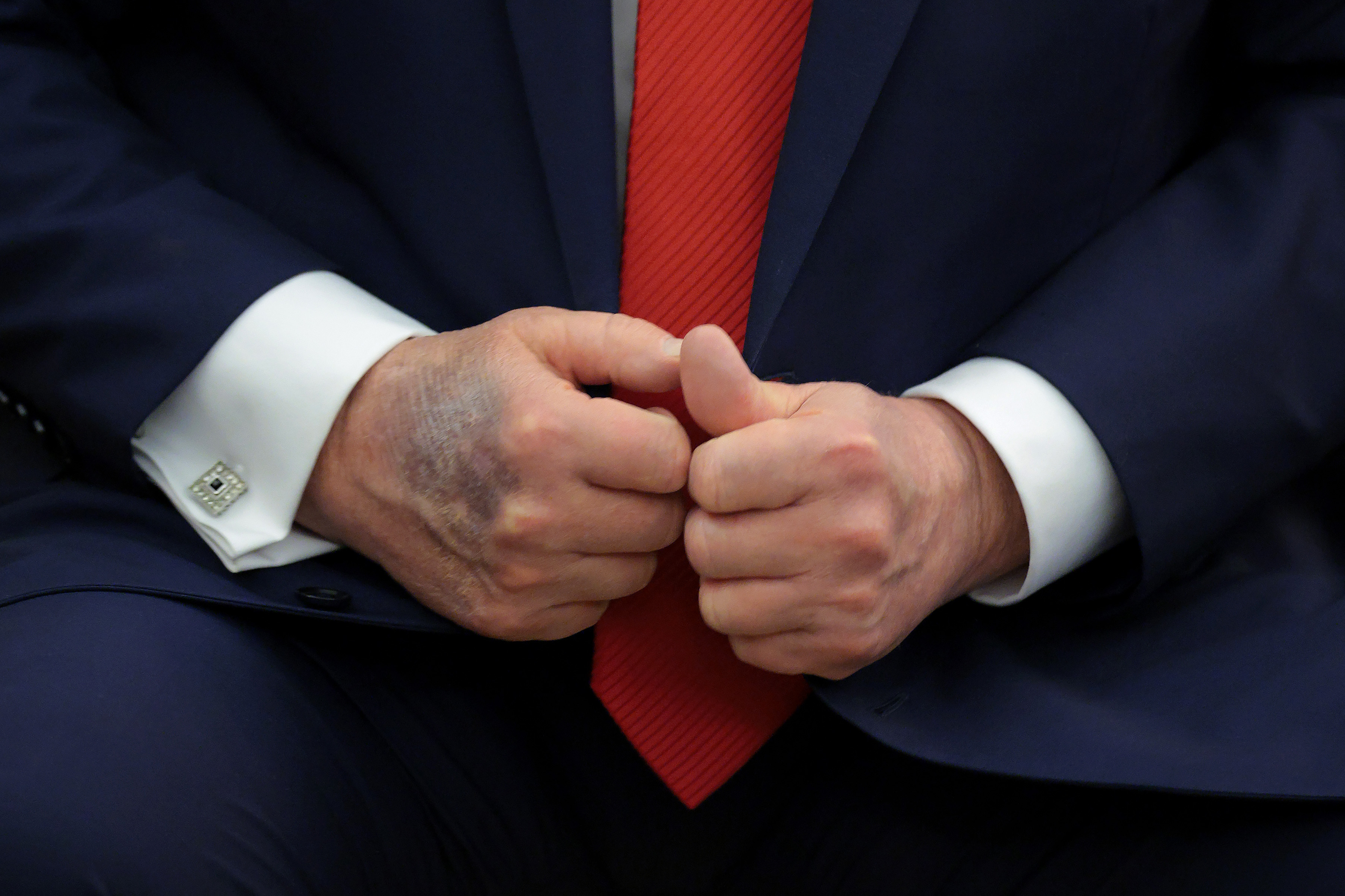 A bruise is visible on the back of Donald Trump's right hand during a meeting with South Korean President Lee Jae-myung in the Oval Office at the White House on August 25, 2025 in Washington, DC | Source: Getty Images