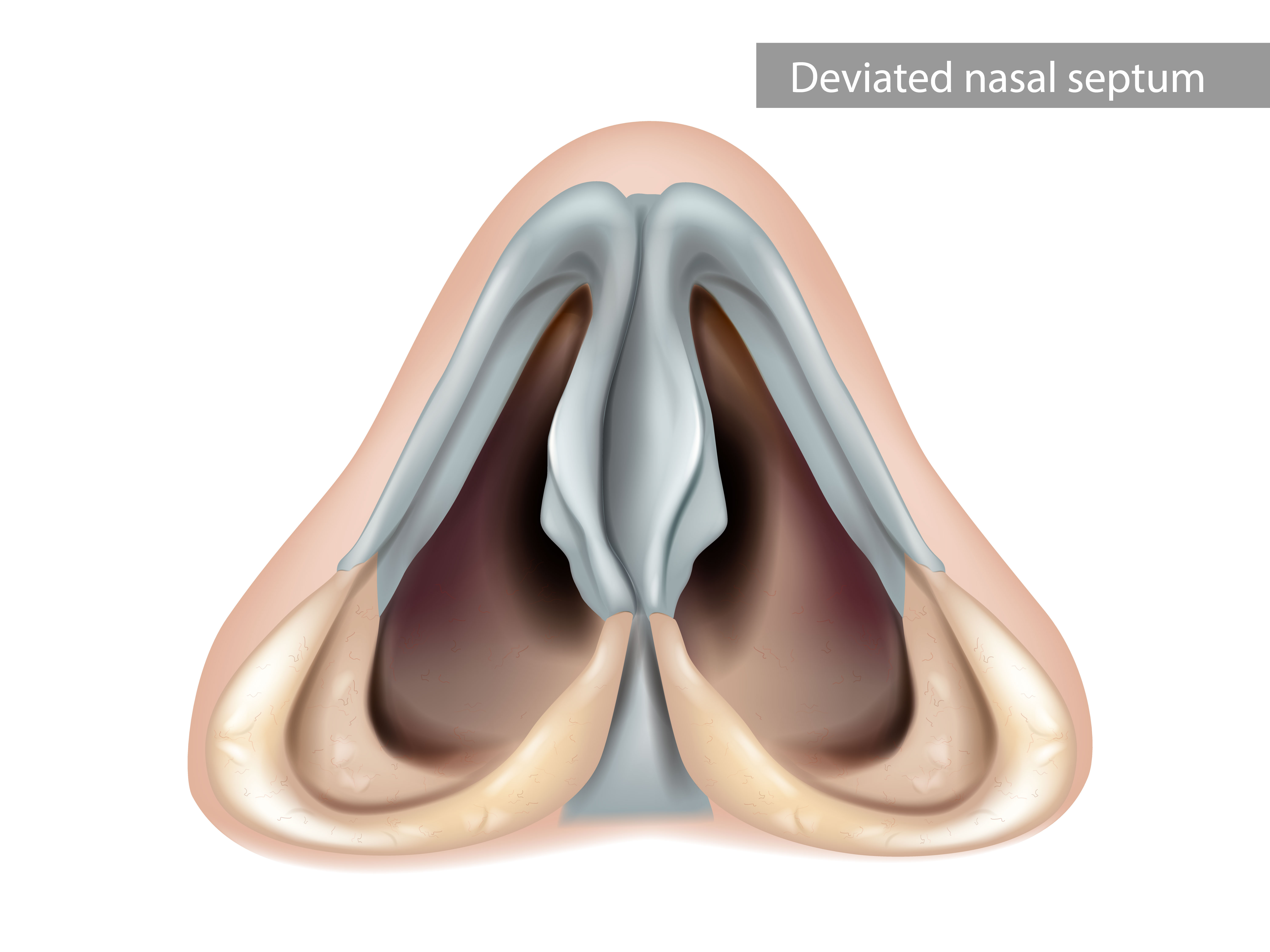 Deviated nasal septum: nasal cavity inferior view | Source: Getty images
