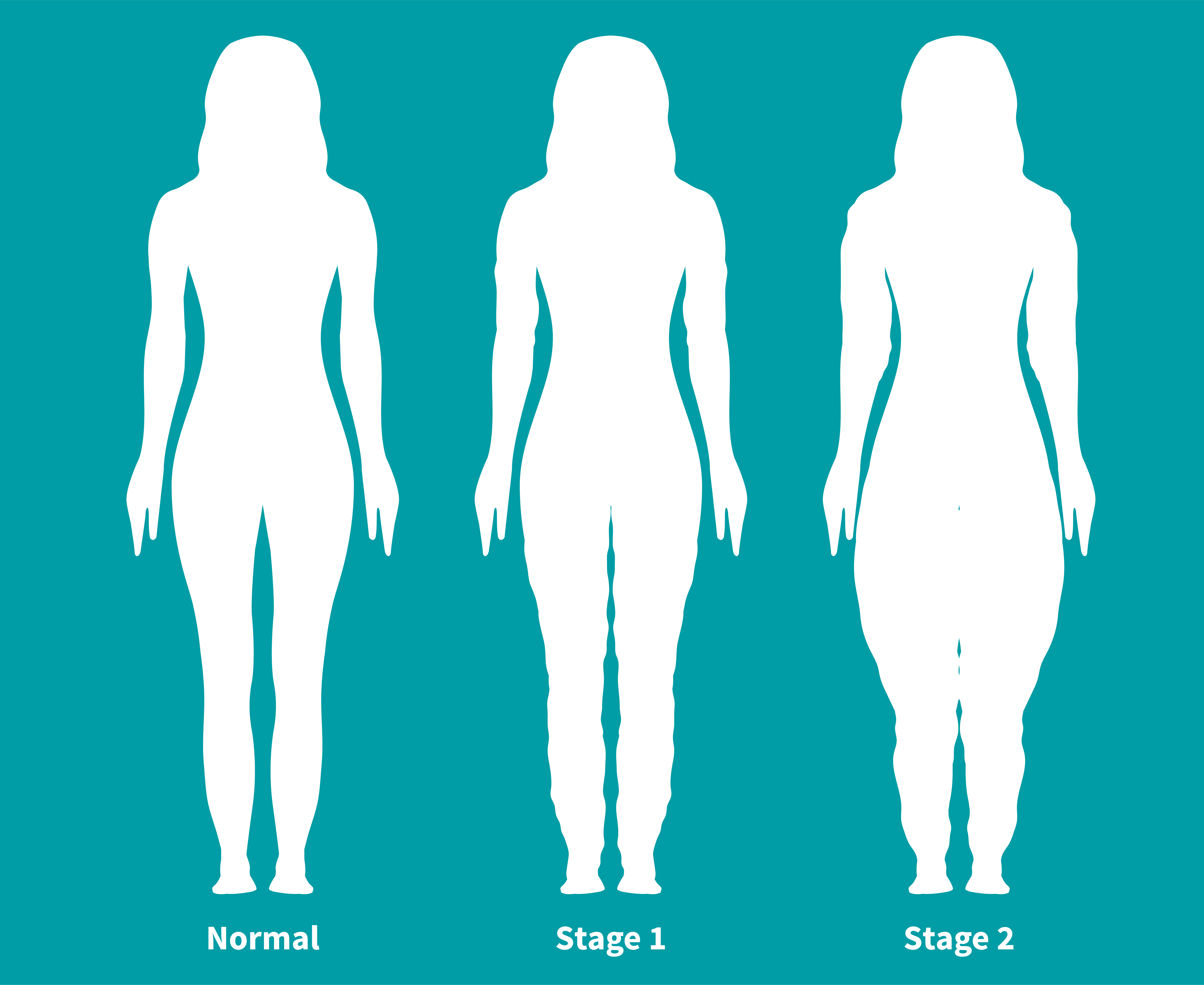 Teal silhouette illustration depicting a woman at various stages of Lipedema, contrasted with a normal body type | Source: Getty Images