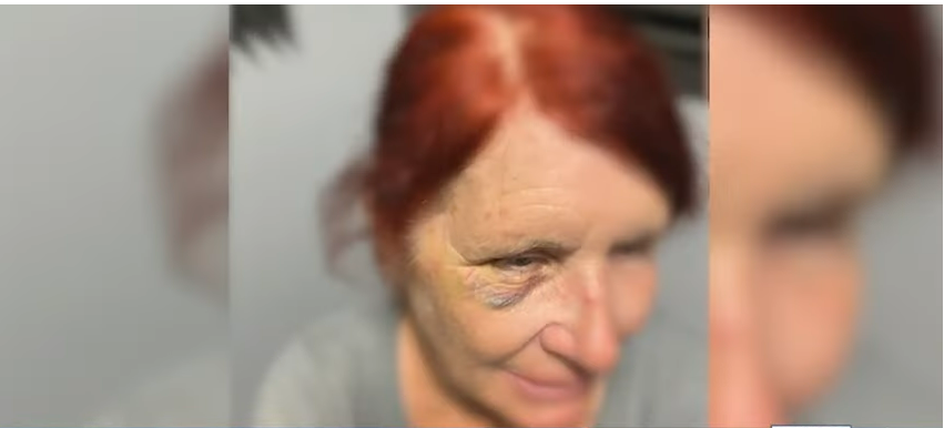 Donna Hansbrough injured eye | Source: Youtube.com/WJCL News