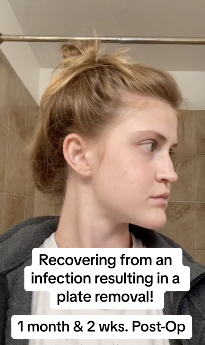 Virginia Elder turns to the side, revealing the structure of her healing jawline. | Source: TikTok/virginiaeelder