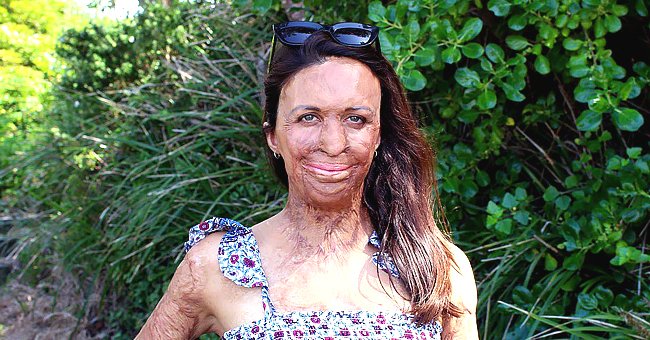 facebook.com/Turia Pitt