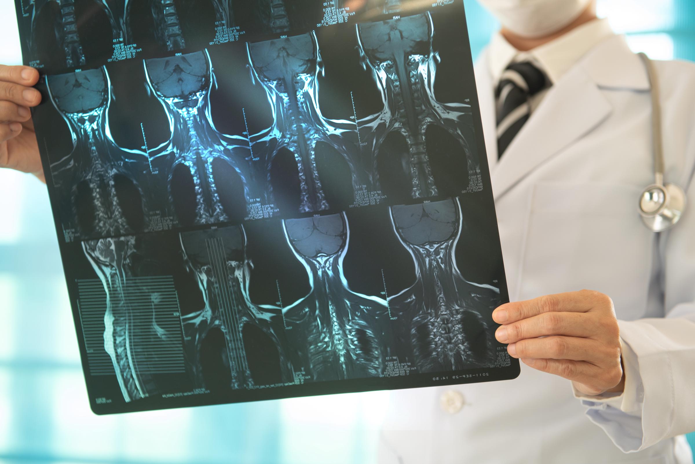 Doctor studies cervical spine X-rays to assess spinal health and detect conditions like cervical spondylosis or thyroid involvement | Source: Getty Images