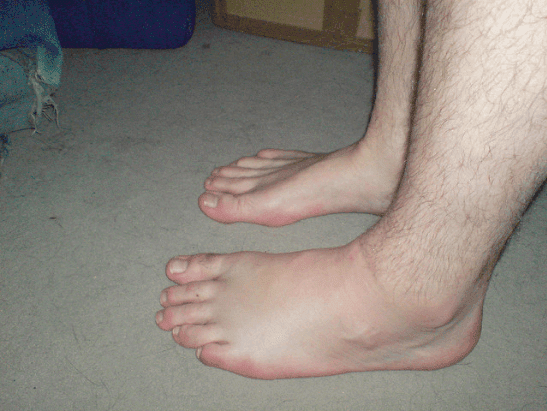 Une vue de l'inflammation du pied gauche d'un homme. | photo : Flickr Une vue de l'inflammation du pied gauche d'un homme. | photo : Flickr