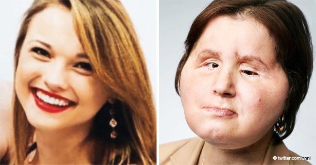 Face transplant gives suicide survivor a second chance