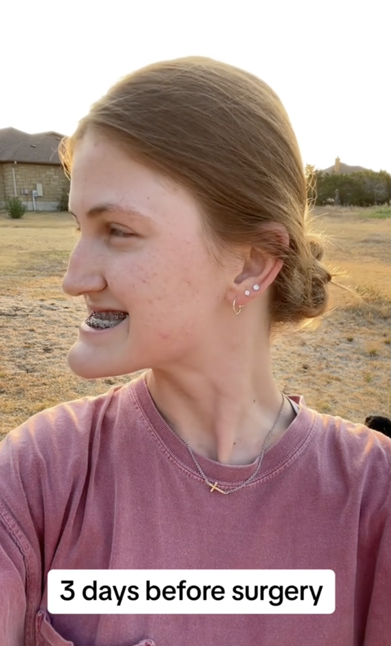 Smiling wide, Virginia Elder gives a glimpse of her pre-op profile with braces. | Source: TikTok/virginiaeelder