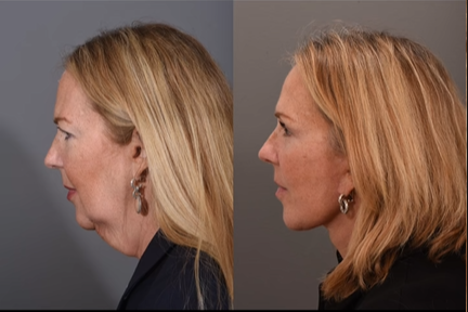 Picture of a woman before and after plastic surgery, dated July 11, 2023 | Source: TikTok/@quatela_center