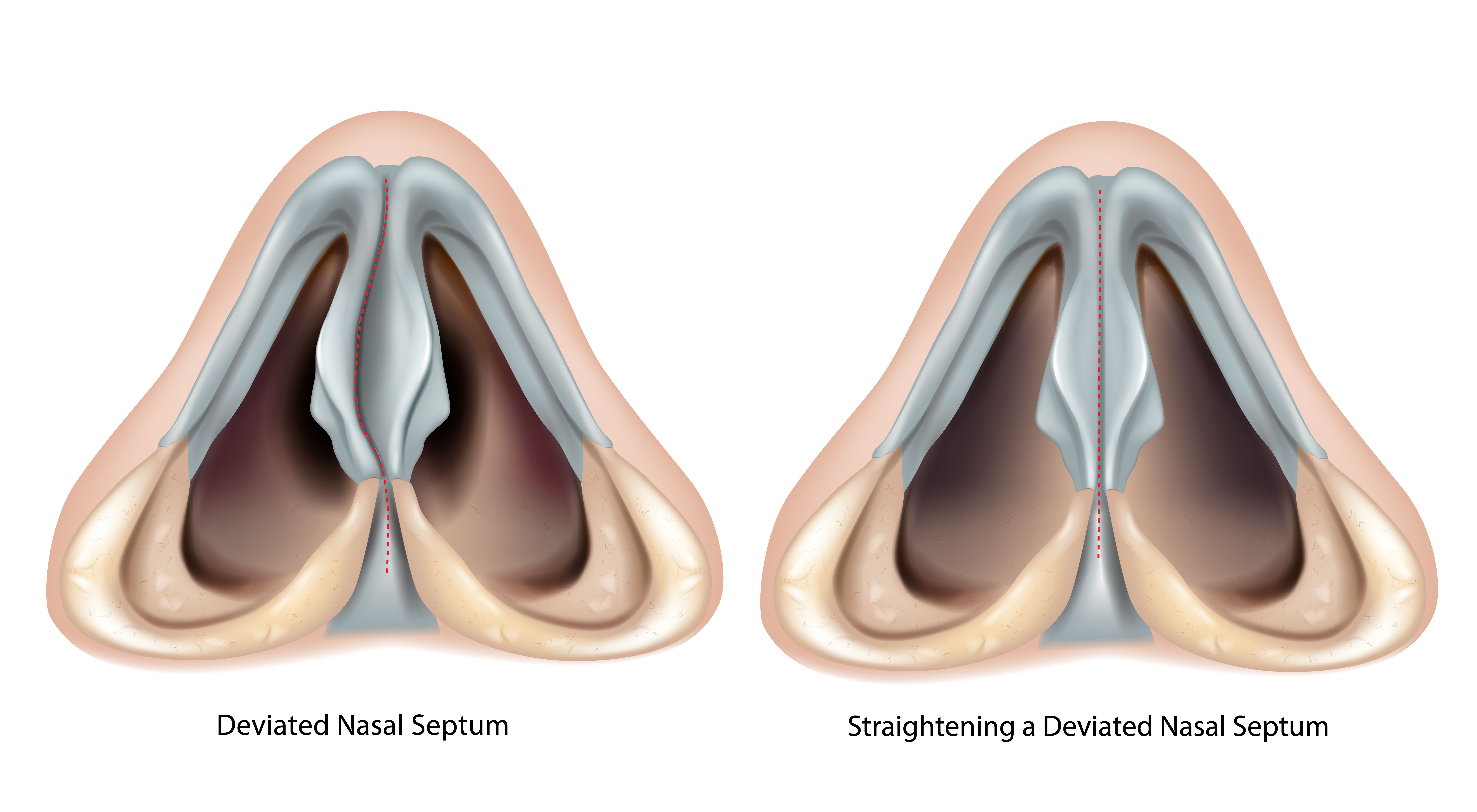 Deviated nasal septum and straightened septum after septoplasty | Source: Getty Images