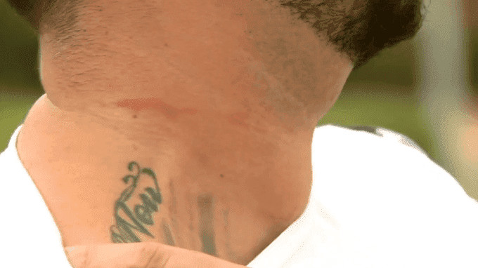 The marks on Brandon Penrose's neck after the confrontation | Photo: 9News