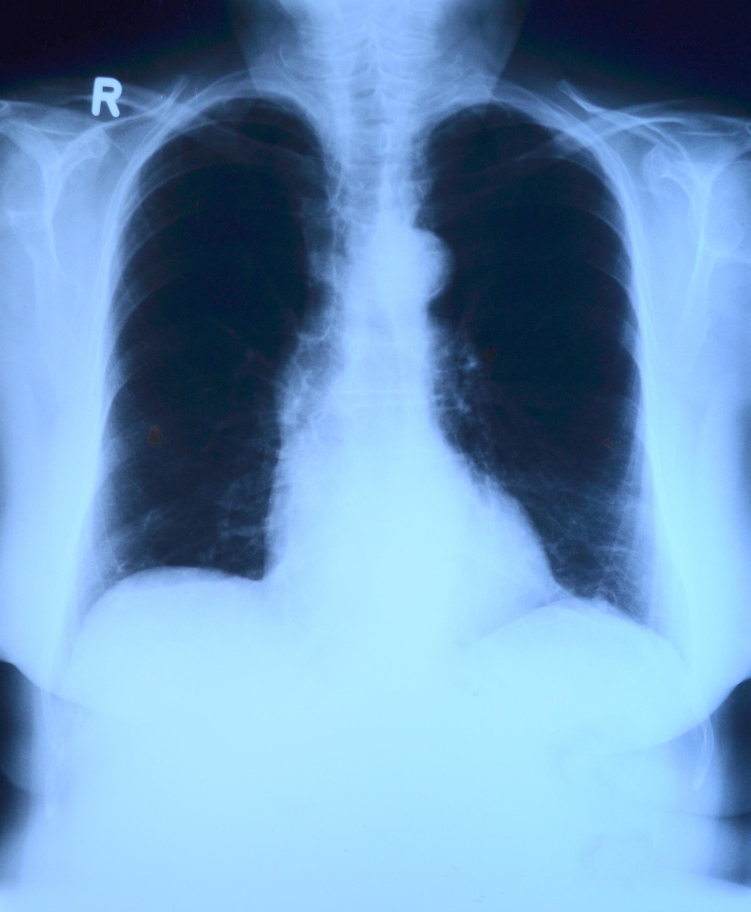 An x-ray of lungs | Source: Pixabay
