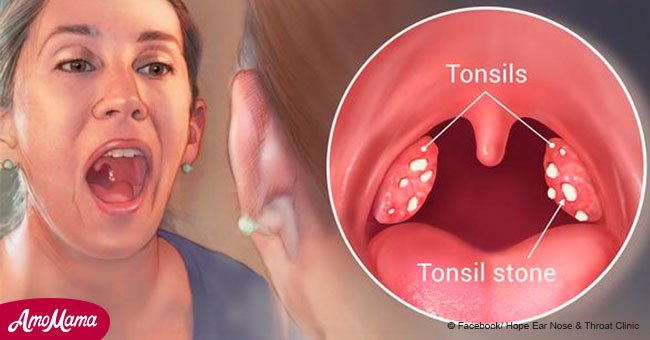 All you need to know about tonsil stones