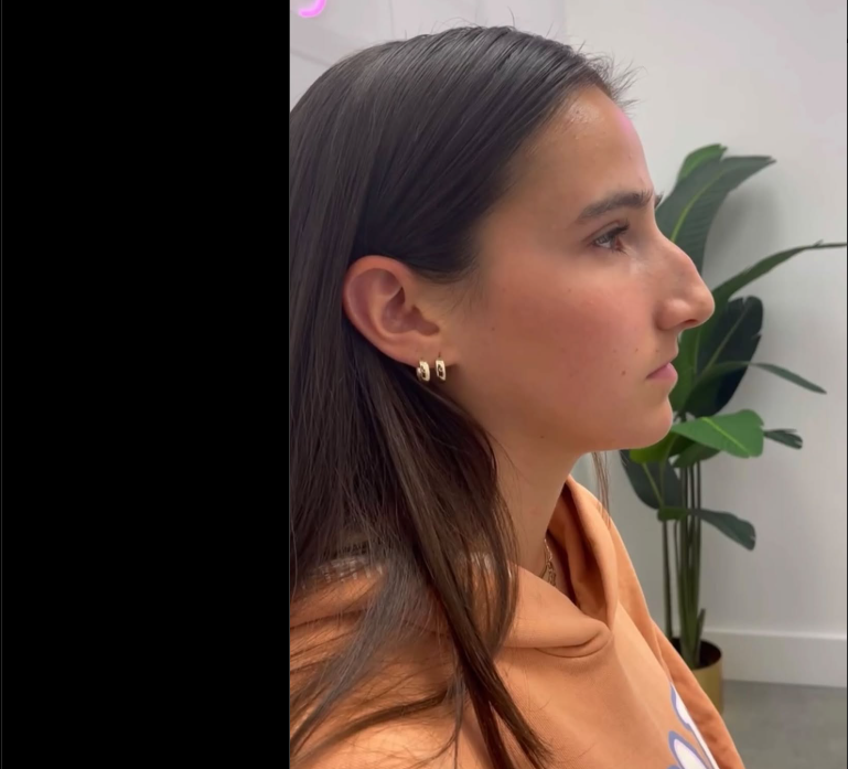 Patient before rhinoplasty, dated August 28, 2023 | Source: Instagram/drkassir