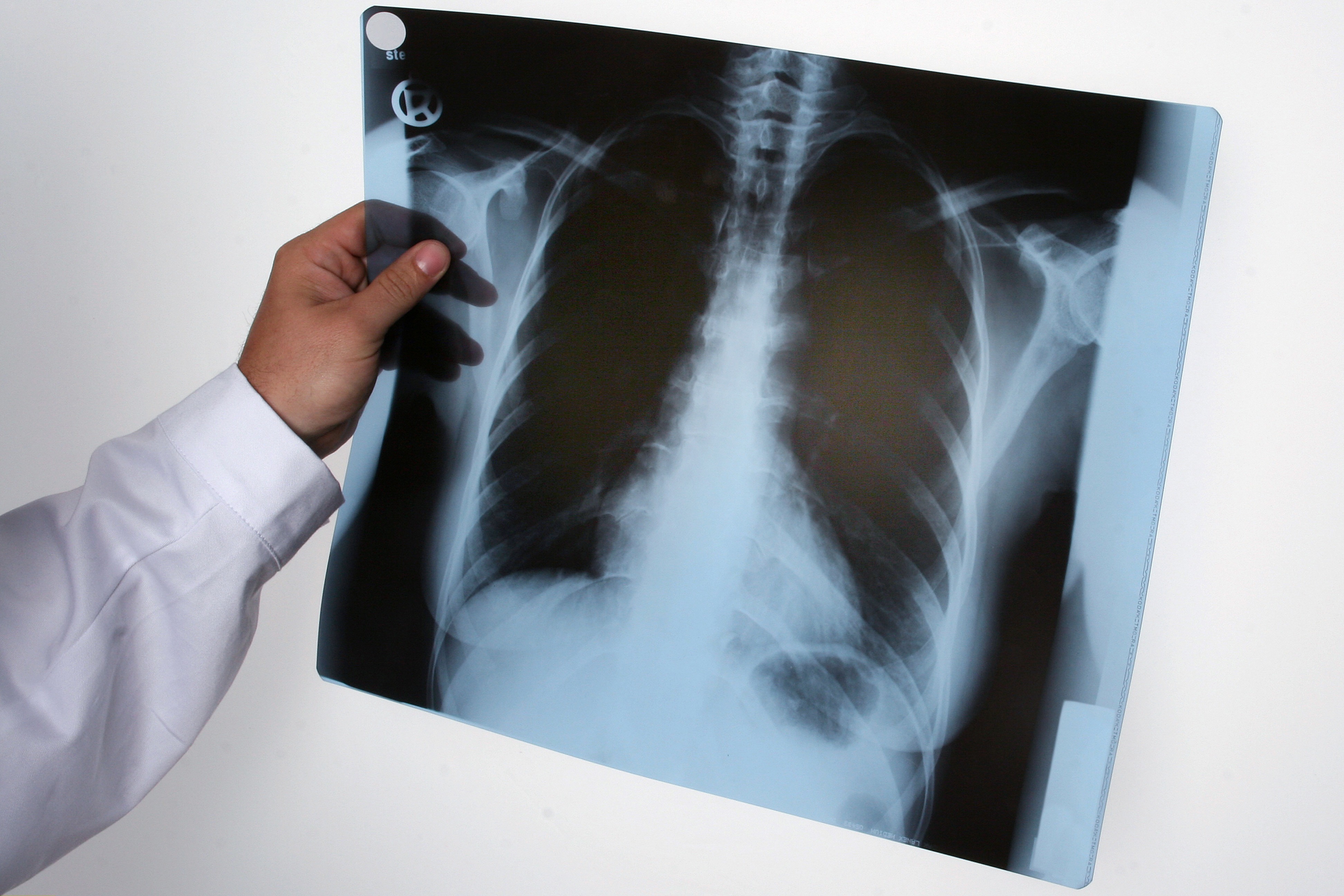 A doctor examines a lung x-ray | Source: Getty Images