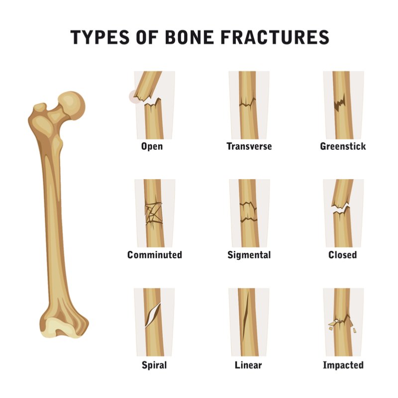 Types Of Bone Fractures. | Source: Shutterstock