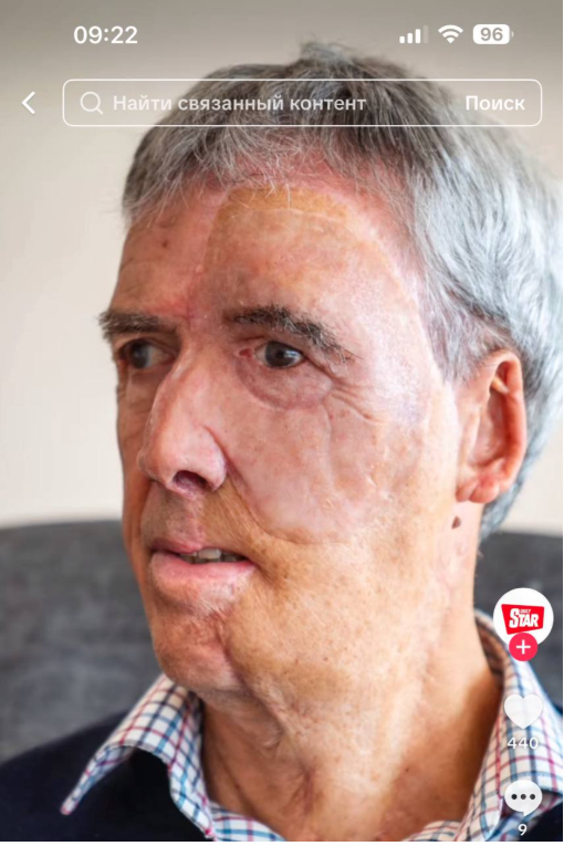 Dave Richards with his prosthetic face on | Source: TikTok/TheDailyStar