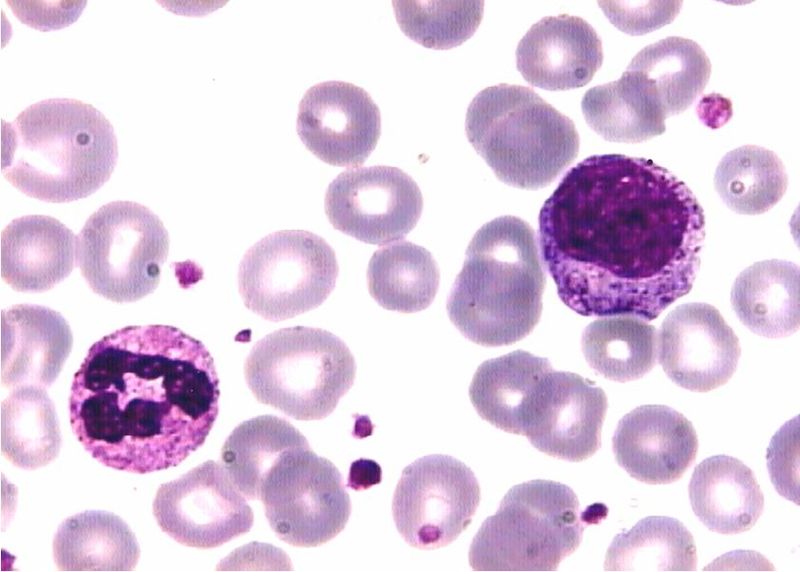 Neutrófilo y mileocito en un caso de Leucemia Mieloide Cronica. | Imagen: Wikipedia