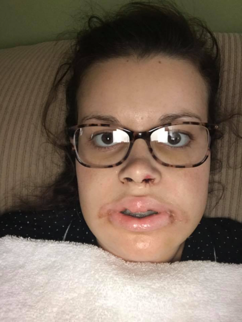 An up-close shot of Katie Wolferding post surgery, dated June 2019 | Source: Facebook/katiewolferding