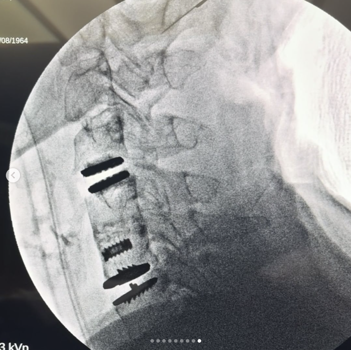 Melissa Gilbert's spine x-ray, dated March 2024 | Source: Instagram/MelissaGilbertOfficial