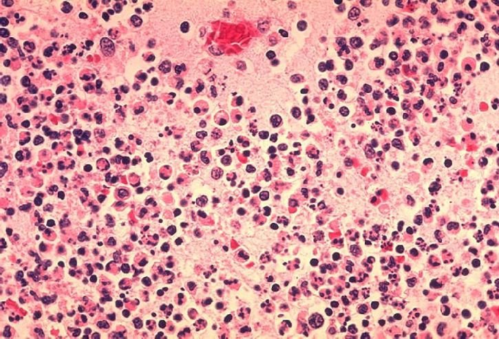 Histopatología ganglios linfáticos. | Imagen: Pixnio Histopatología ganglios linfáticos. | Imagen: Pixnio