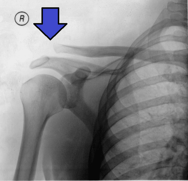 Radiografía de fractura del hombro. | Foto: Wikipedia
