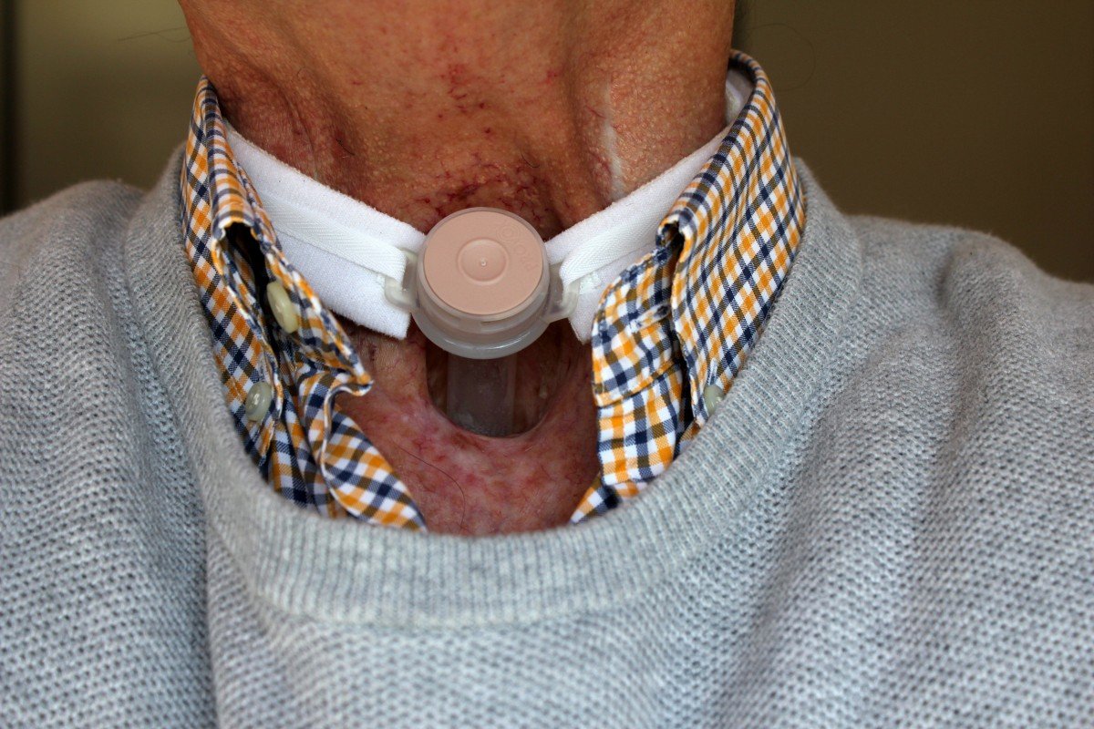 Hombre de edad avanzada mostrando una traqueotomía. | Imagen: PxHere
