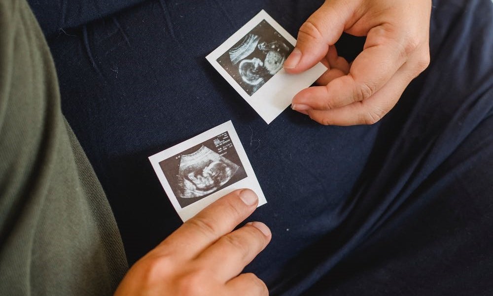 Couple with sonogram images in hands. | Photo: Pexels