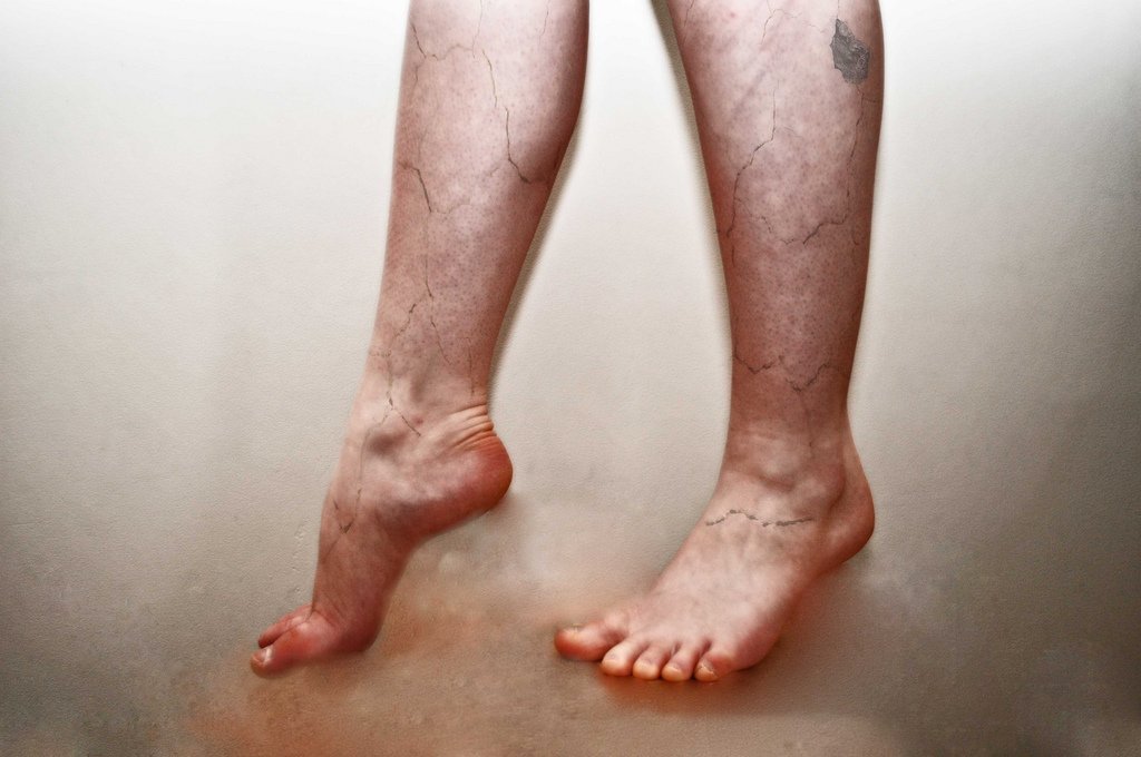 Piernas con venas varicosas. | Imagen: Flickr Piernas con venas varicosas. | Imagen: Flickr