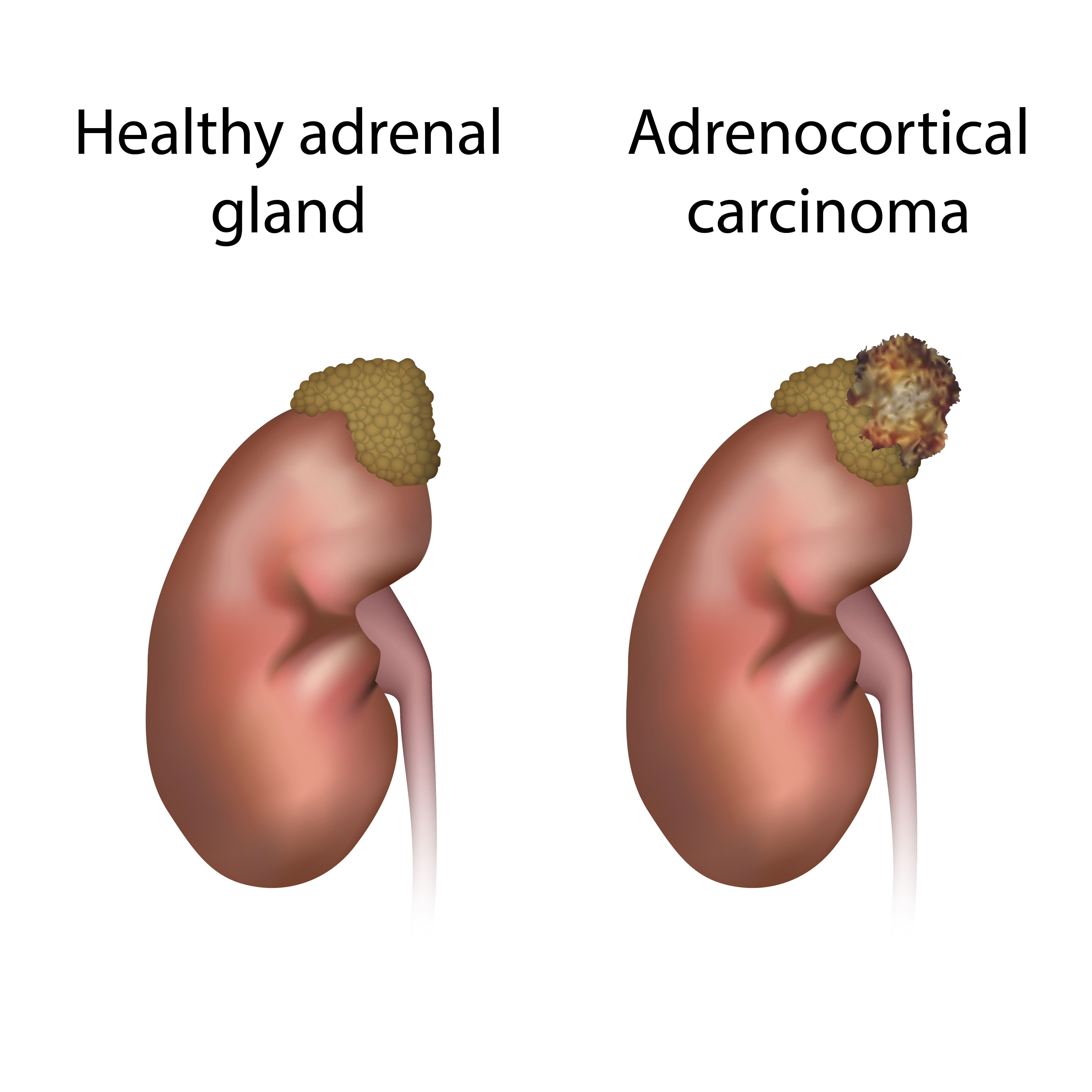 Illustration comparing adrenocortical carcinoma with a healthy adrenal gland, highlighting the differences in structure and appearance | Source: Getty Images
