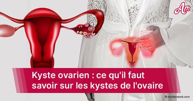 Les kystes ovariens : les 5 symptômes les plus communs qui indiquent ...