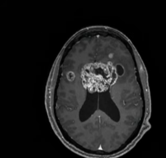 An image of Jason Collins's cancer, from a video post dated December 11, 2025. | Source: YouTube/ESPN