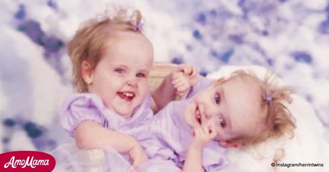 Conjoined twins became famous in 2002. Now they live healthy lives and look unrecognizable