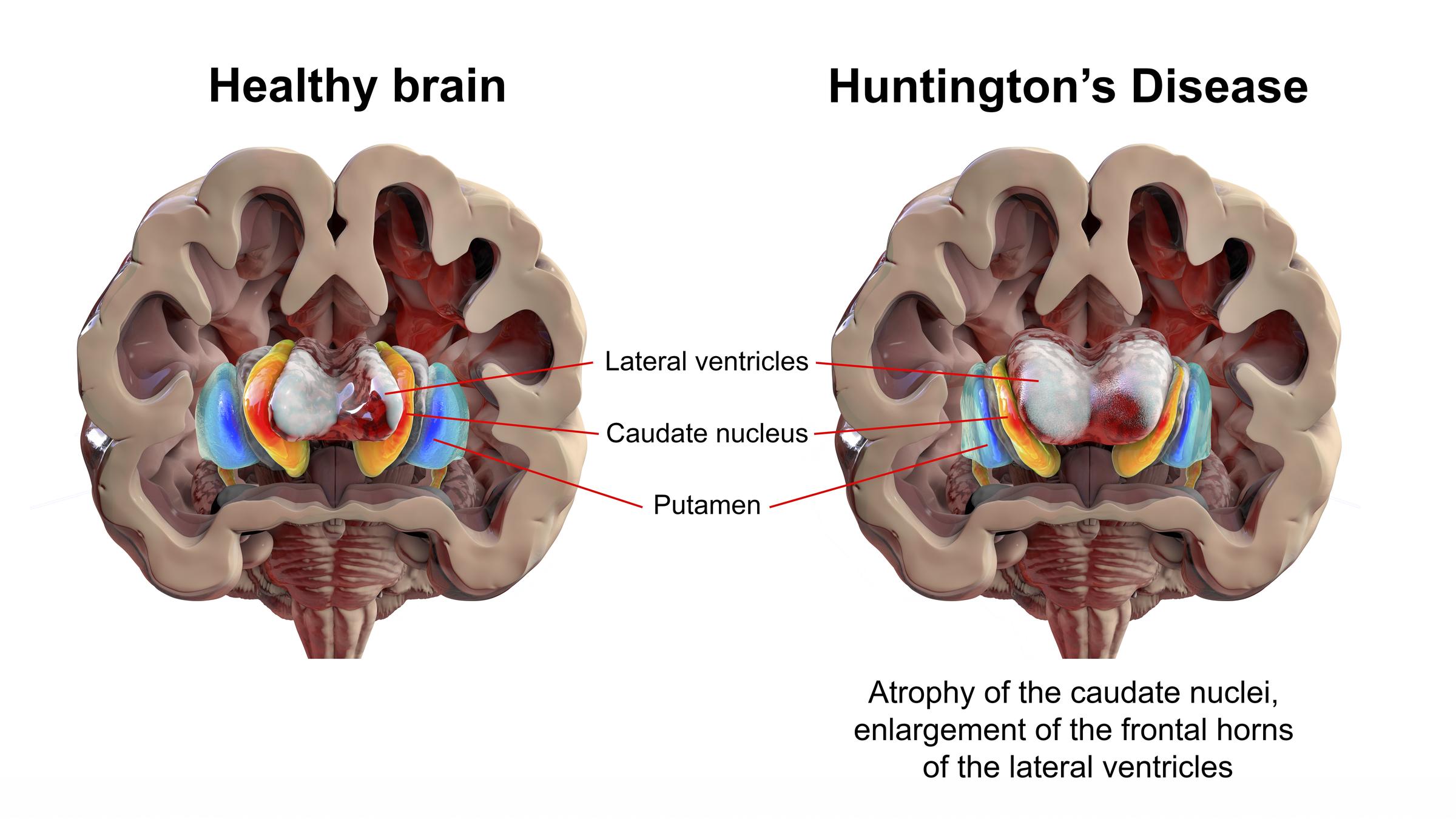 The dorsal striatum and lateral ventricles in a healthy brain and one with Huntington's disease (HD) | Source: Getty Images