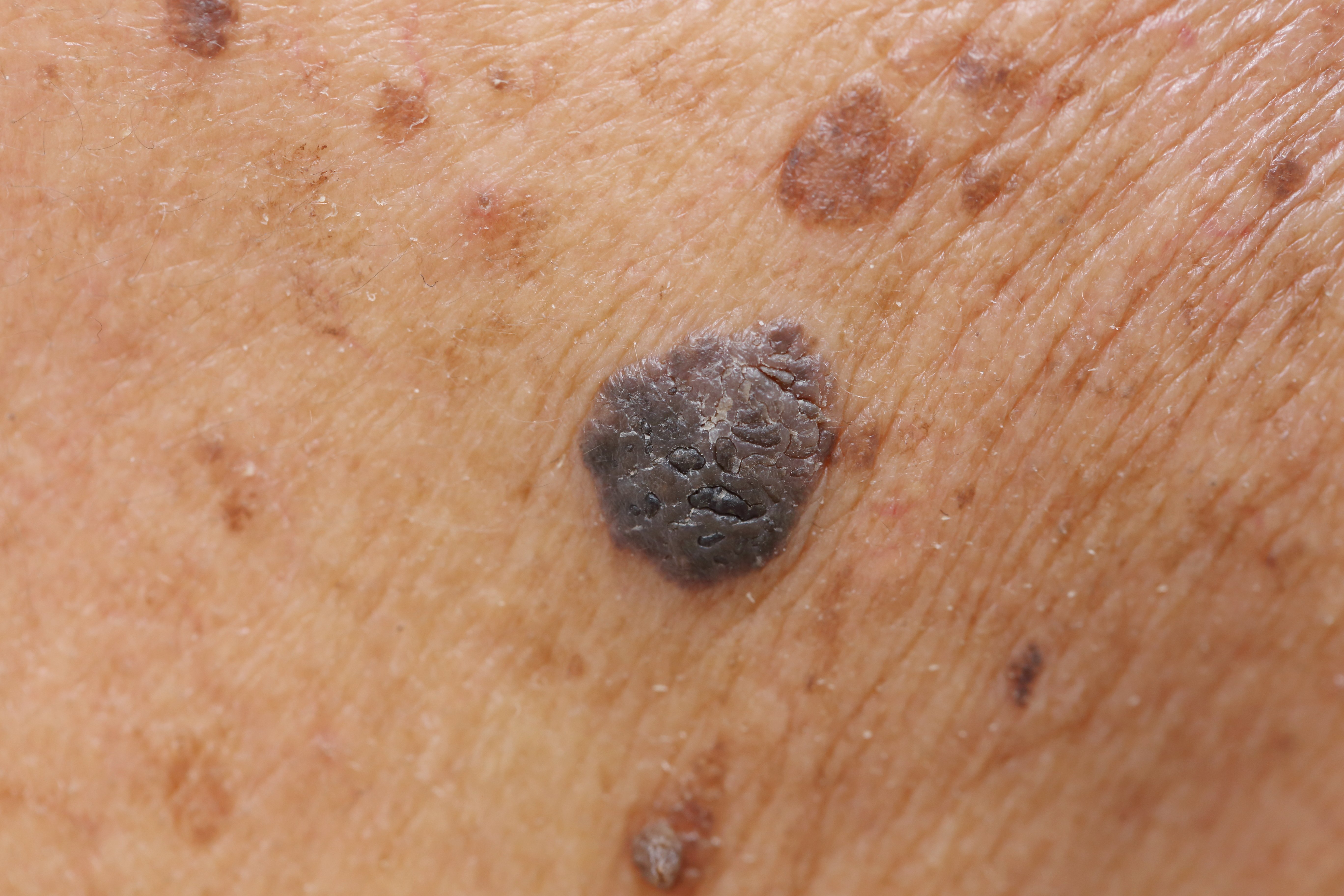 Lunares melanoma| Foto: Pixabay