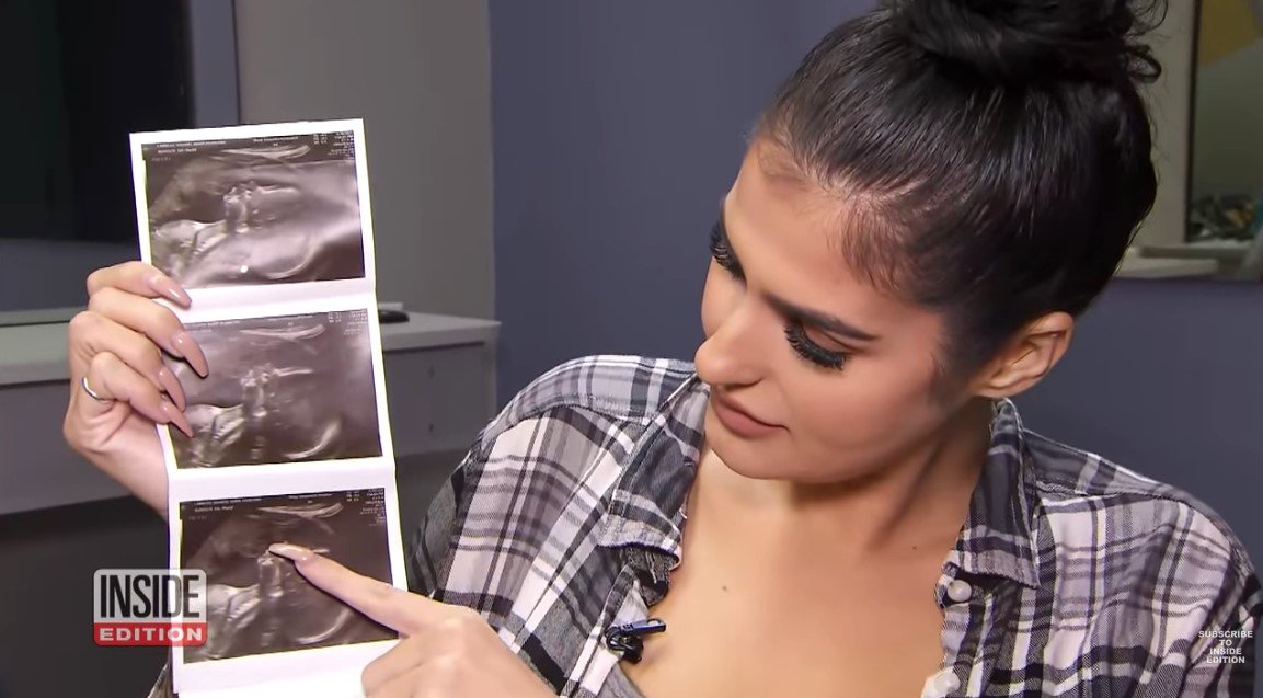 Picture of Shantel Carrillo pointing at her ultrasound photo | Source: Youtube/ Inside Edition