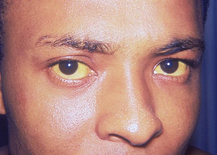 Blanco del ojo con tono amarillento. | Imagen: Wikimedia Commons Blanco del ojo con tono amarillento. | Imagen: Wikimedia Commons