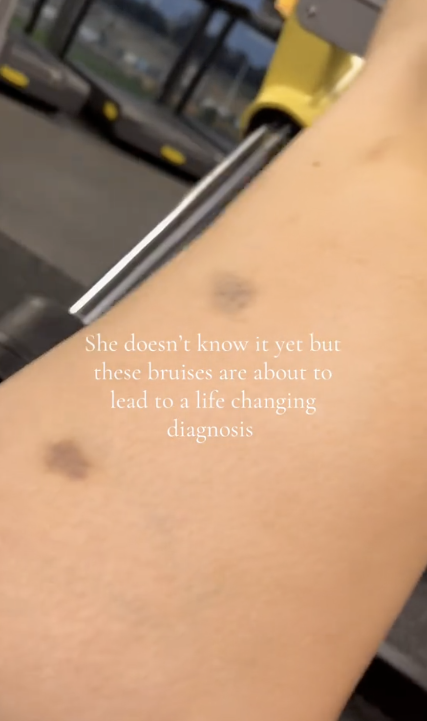 Taylor Omalley's bruised leg as seen in a post dated May 14, 2025 | Source: TikTok/pt_tayloromalley
