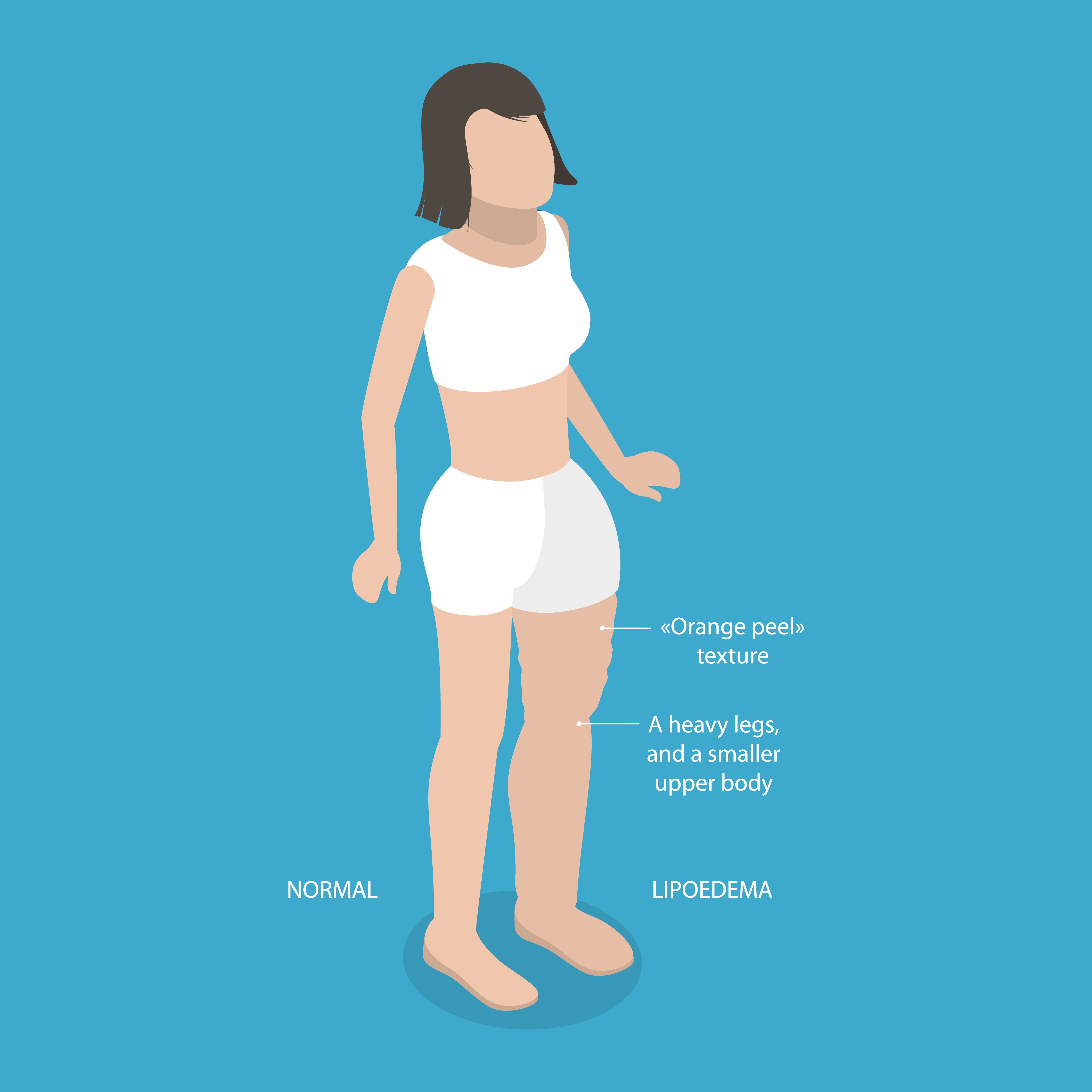 3D isometric flat vector illustration depicting Lipedema and overweight-related concerns | Source: Getty Images