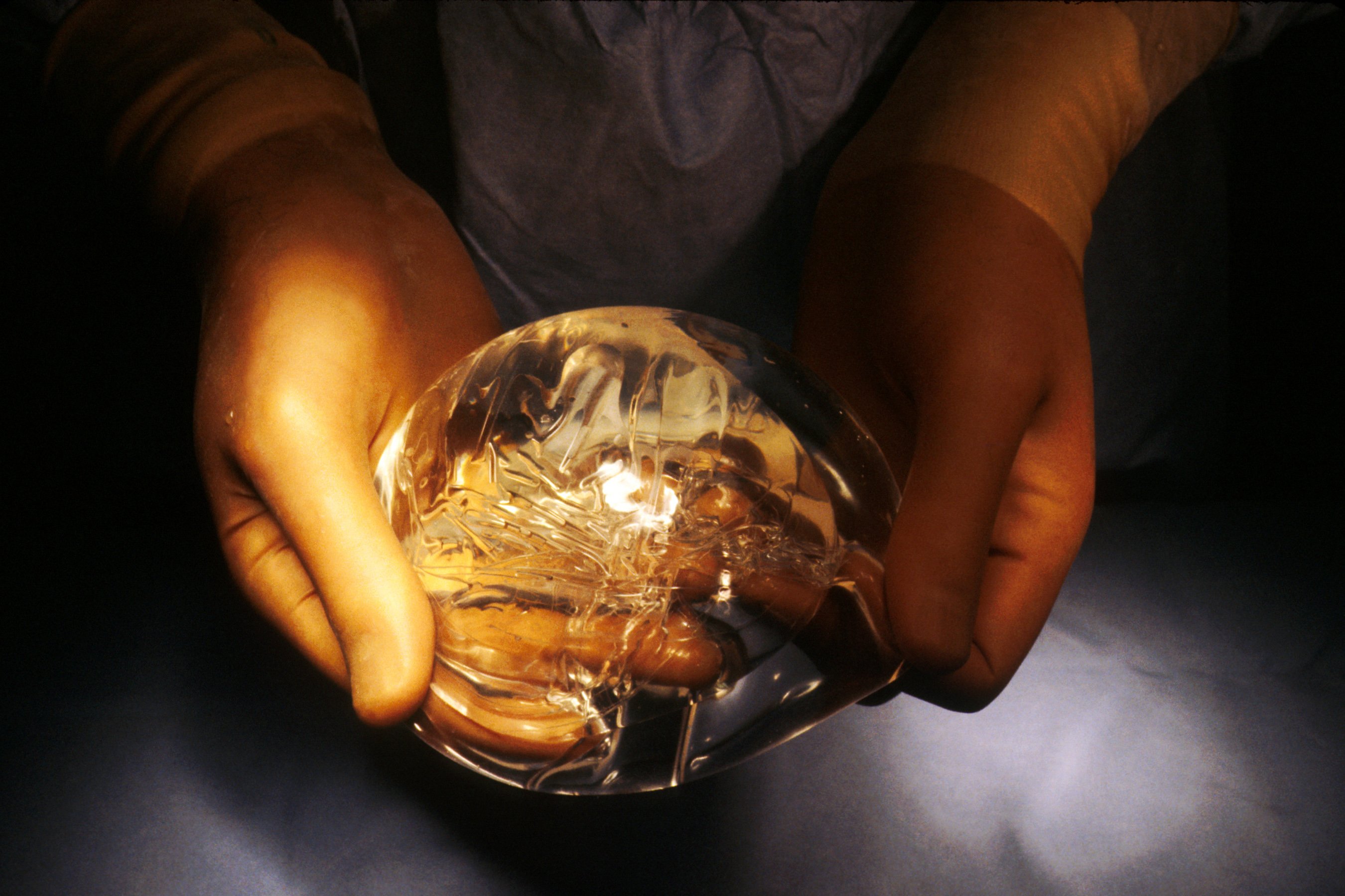Implante mamario.| Imagen: Wikimedia Commons