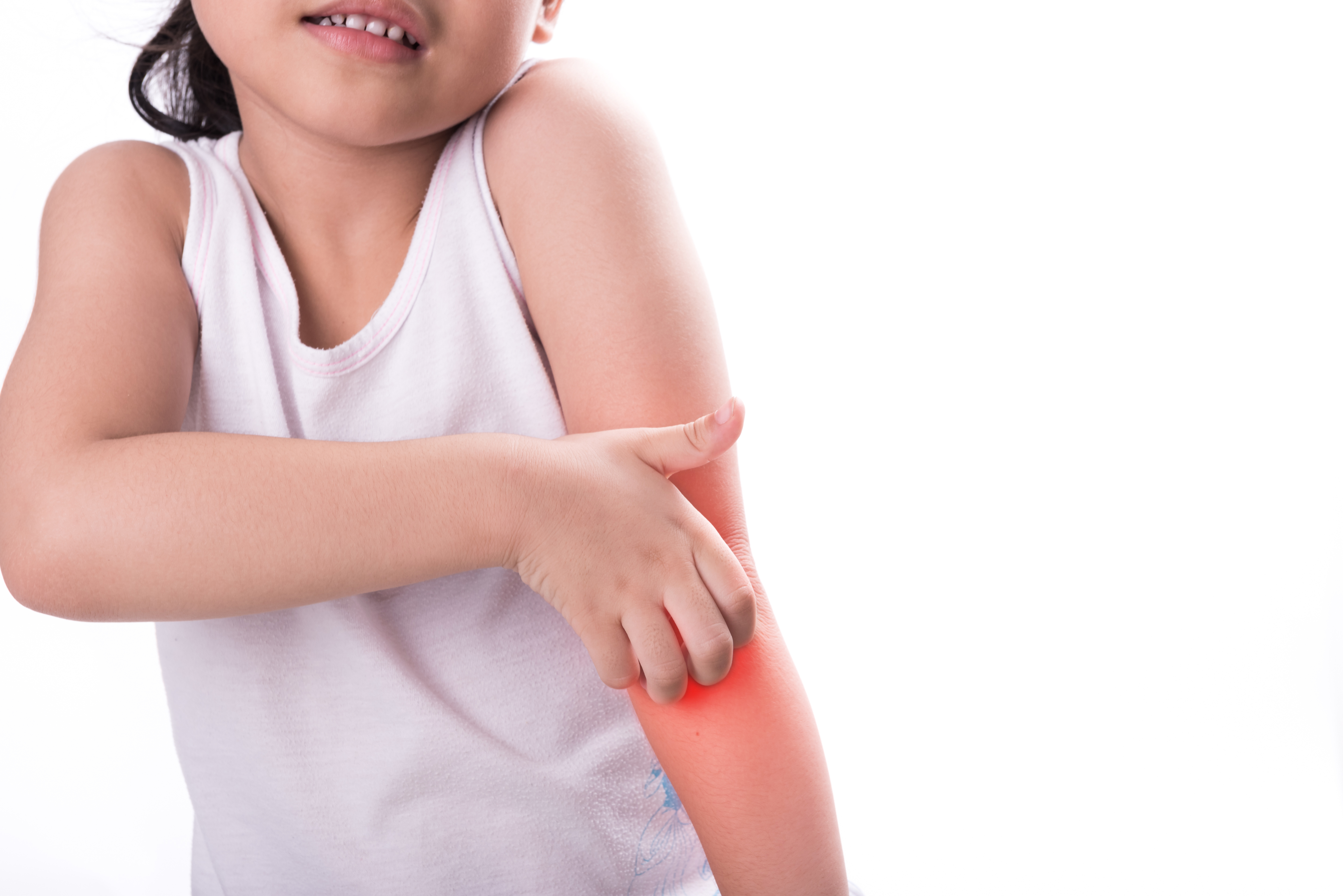 Ein Kind, das sich die Arme kratzt | Quelle: Shutterstock