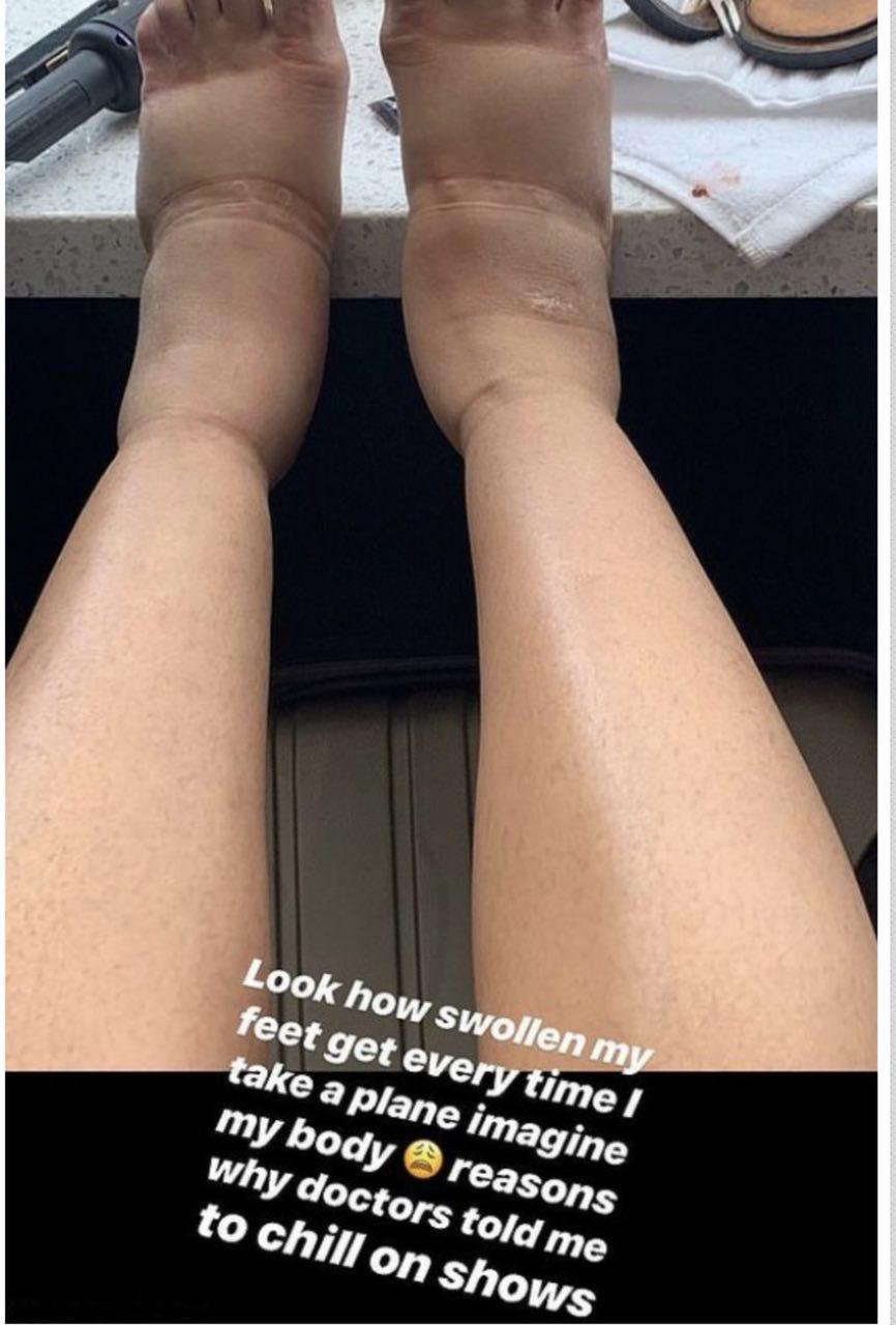 Cardi B's swollen feet after undergoing plastic surgery. | Source: @iamcardib Instagram