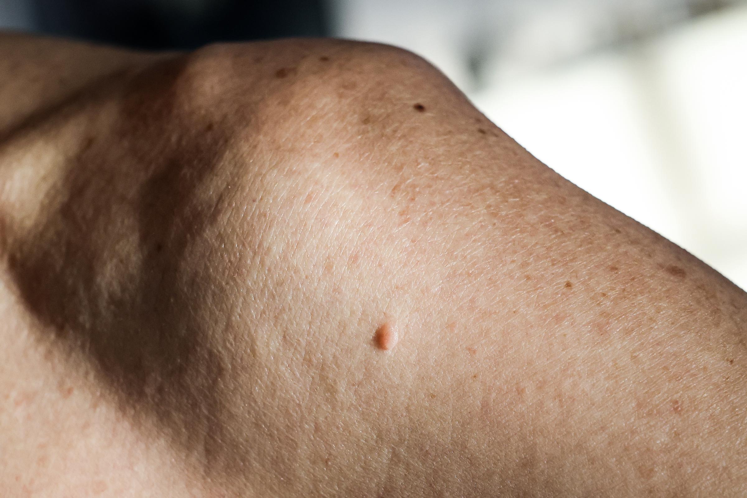 Close-up of a person's shoulder showing pigmented spots on the skin | Source: Getty Images