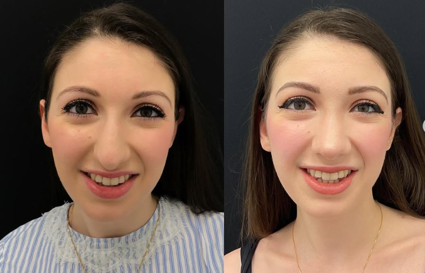 Patient before and after rhinoplasty, dated June 21, 2022 | Source: Instagram/drkassir