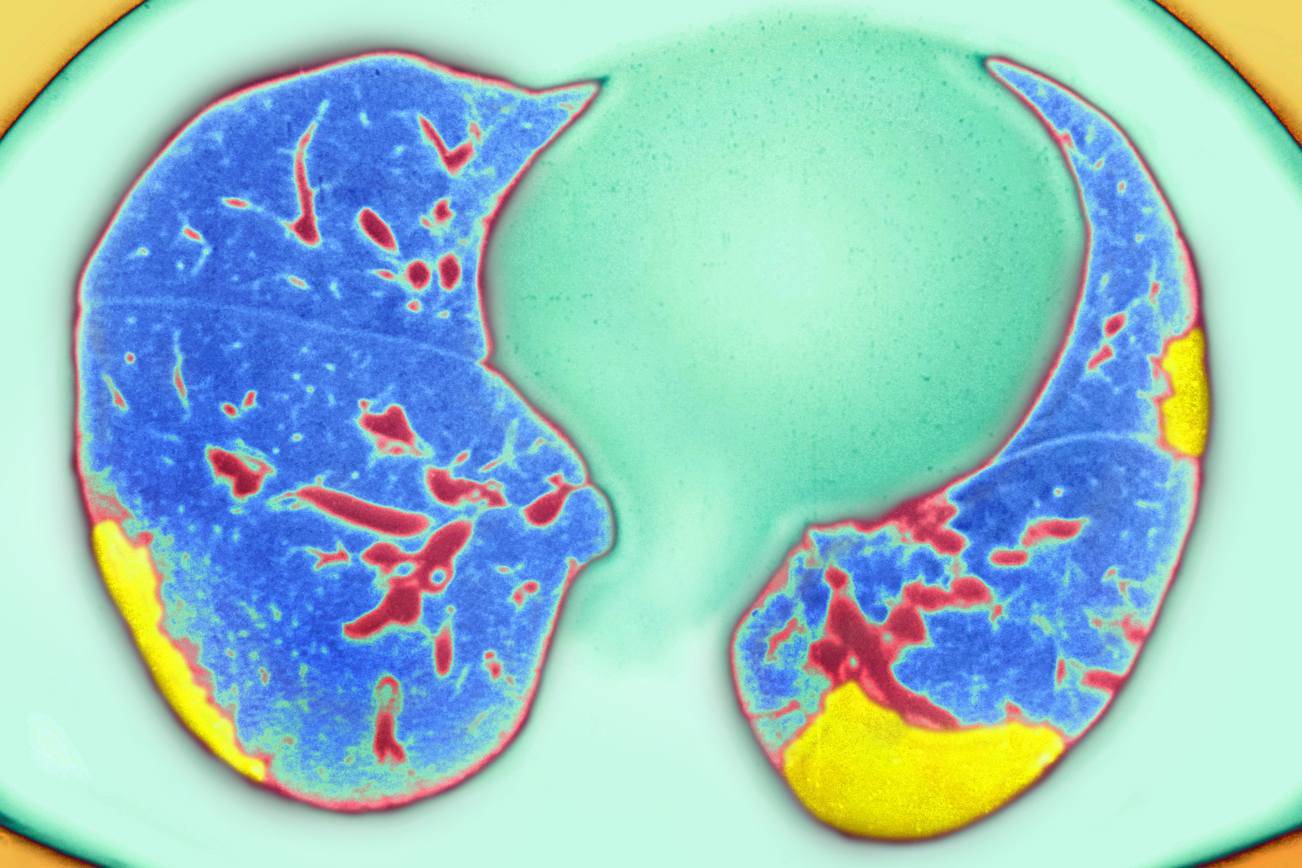 Pulmonary embolism seen on a radial cross-section chest CT scan. | Source: Getty Images