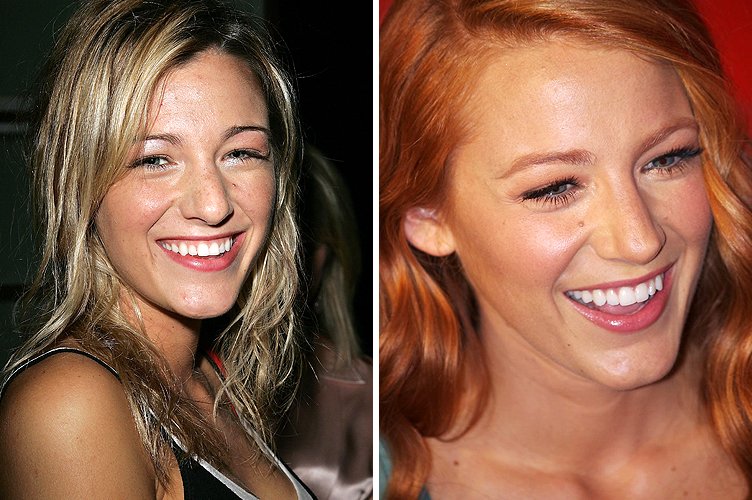 Blake Lively avant et après. ǀ Source : Getty Images