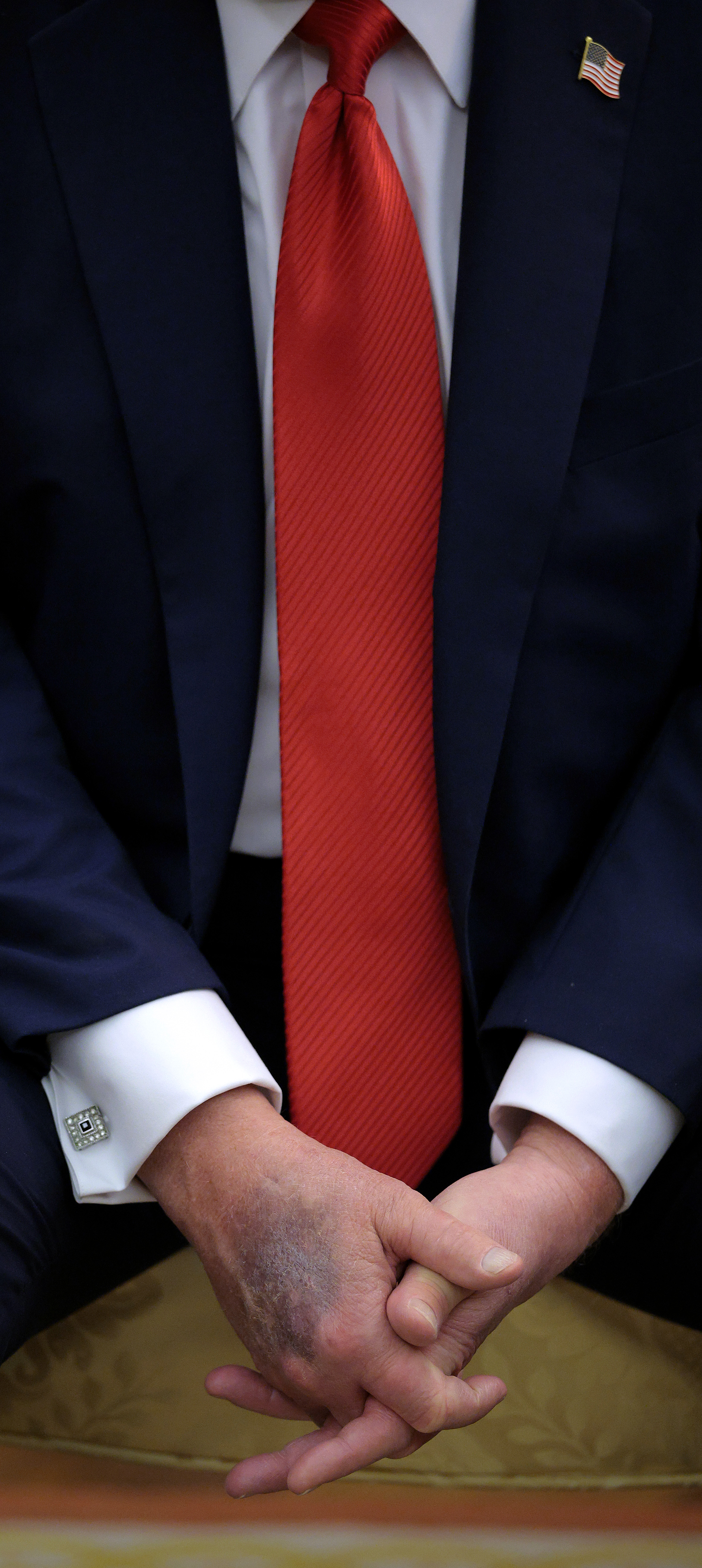 A bruise is visible on the back of President Donald Trump's right hand during a meeting with South Korean President Lee Jae-myung at the White House on August 25, 2025, in Washington, D.C. | Source: Getty Images