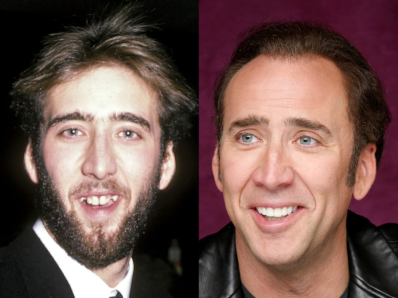 A before and after of Nicolas Cage's smile. | Source: Getty Images