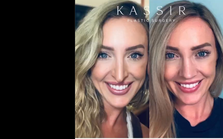 Patient before and after the revision procedure, dated August 26, 2023 | Source: Instagram/drkassir